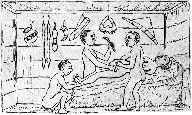 A caesarean section performed by indigenous healers in Kahura, in the kingdom of Bunyoro (present-day Uganda) as observed by medical missionary Robert