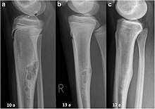 Fibroma non ossificante-RX.jpg