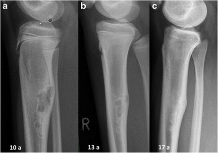 Non-ossifying fibroma of tibia