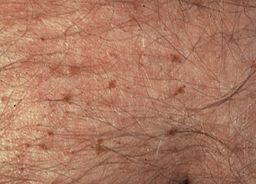 Bộ sưu tập Côn trùng - Page 22 256px-Fig._2._Pubic_lice_in_abdomen