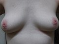 Inverted Nipples.jpg