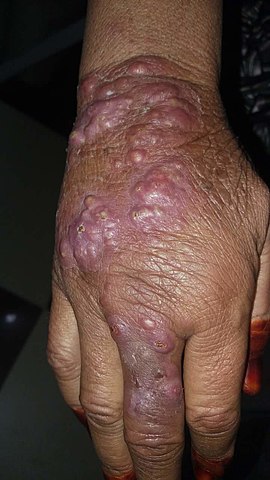 File:Leshmaniasis new photo to help in diagnosis.jpg - Wikipedia