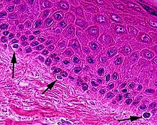 Micrograph of melanocytes in the epidermis.jpg