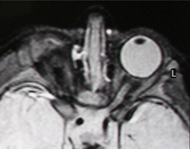 Правосторонняя анофтальмия (МРТ-изображение)