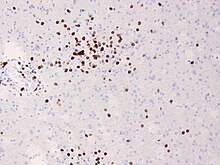 Brain biopsy in Rasmussen's encephalitis showing lymphocytic infiltrates staining for CD8 on immunohistochemistry Rasmussen Brainbiopsy CD8.jpg