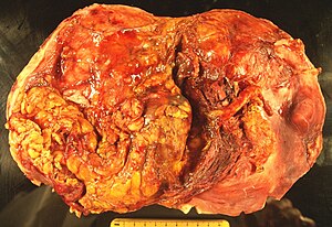 Renal Mucinous spindle 1.JPG