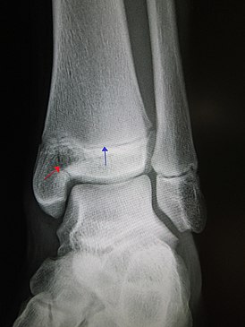 Рентгеновский снимок голеностопного сустава с эпифизеолизом медиальной лодыжки. Красная стрелка - линия перелома, синяя указывает на ростковую зону.