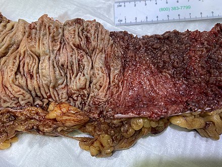 Gross pathology of normal colon (left) and severe ulcerative colitis (right), forming pseudopolyps (smaller than the cobblestoning typically seen in Crohn's disease), over a continuous area (rather than skip lesions of Crohn's disease), and with a relatively gradual transition from normal colon (while Crohn's is typically more abrupt).