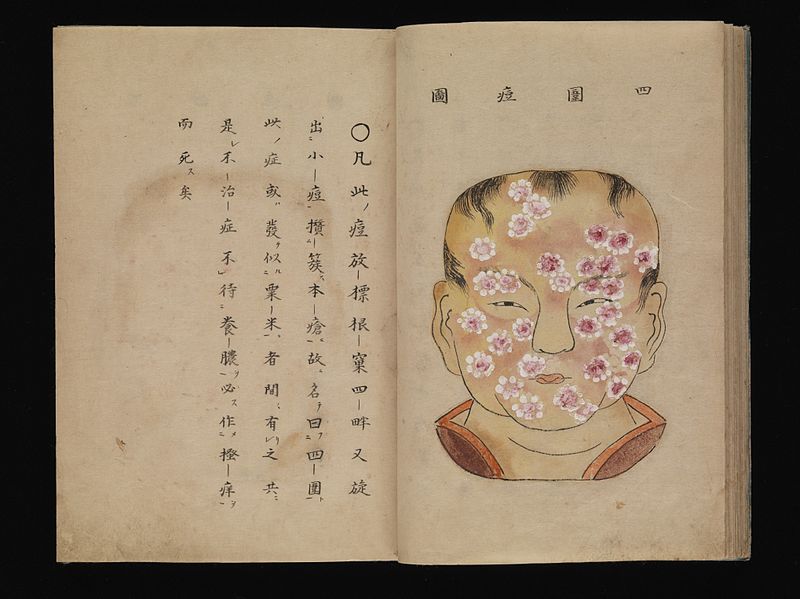 File:Smallpox illustration, Japanese manuscript, c. 1720 Wellcome L0074723.jpg