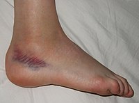 Sprained foot.jpg