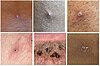 Stages of monkeypox lesion development.jpg
