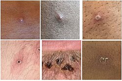 Stages of monkeypox lesion development.jpg
