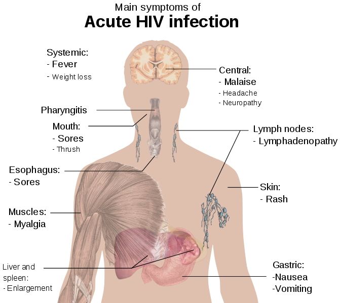 File:Symptoms of acute HIV infection.svg