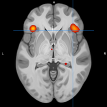 Bilaterally reduced activity in the inferior frontal gyrus (BA47). Image at Talairach z=2 BPM Replication.png