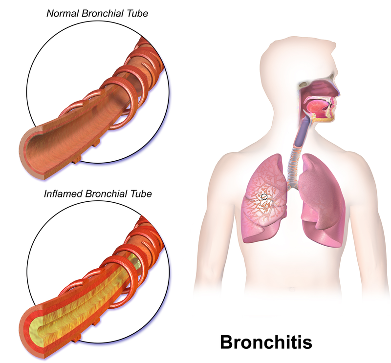 Bronchitis What's The