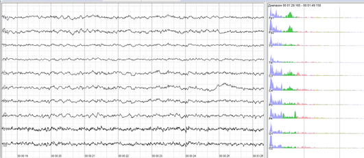 Human EEG without alpha-rhythm.png