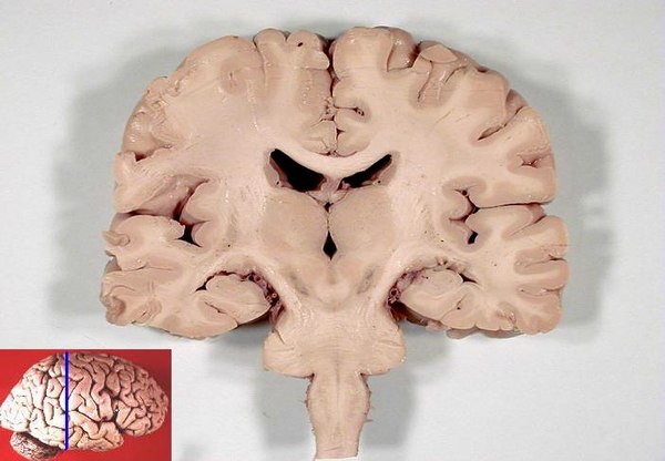 Human brain frontal (coronal) section.JPG