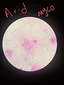 Kinyoun stain on organism Mycobacterium smegmatis Kinyoun Stain, organism Mycobacterium smegmatis.jpg