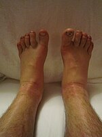 Edema of both legs after walking more than 100 kilometers