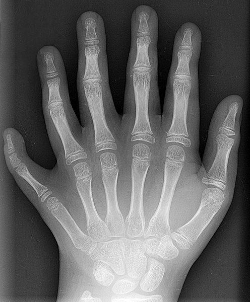 Radiogram of a polydactyl left hand.