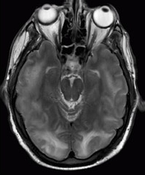 File:Posterior reversible encephalopathy syndrome MRI.jpg