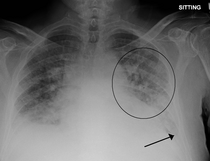 Pulmonary edema PulmEdema.PNG