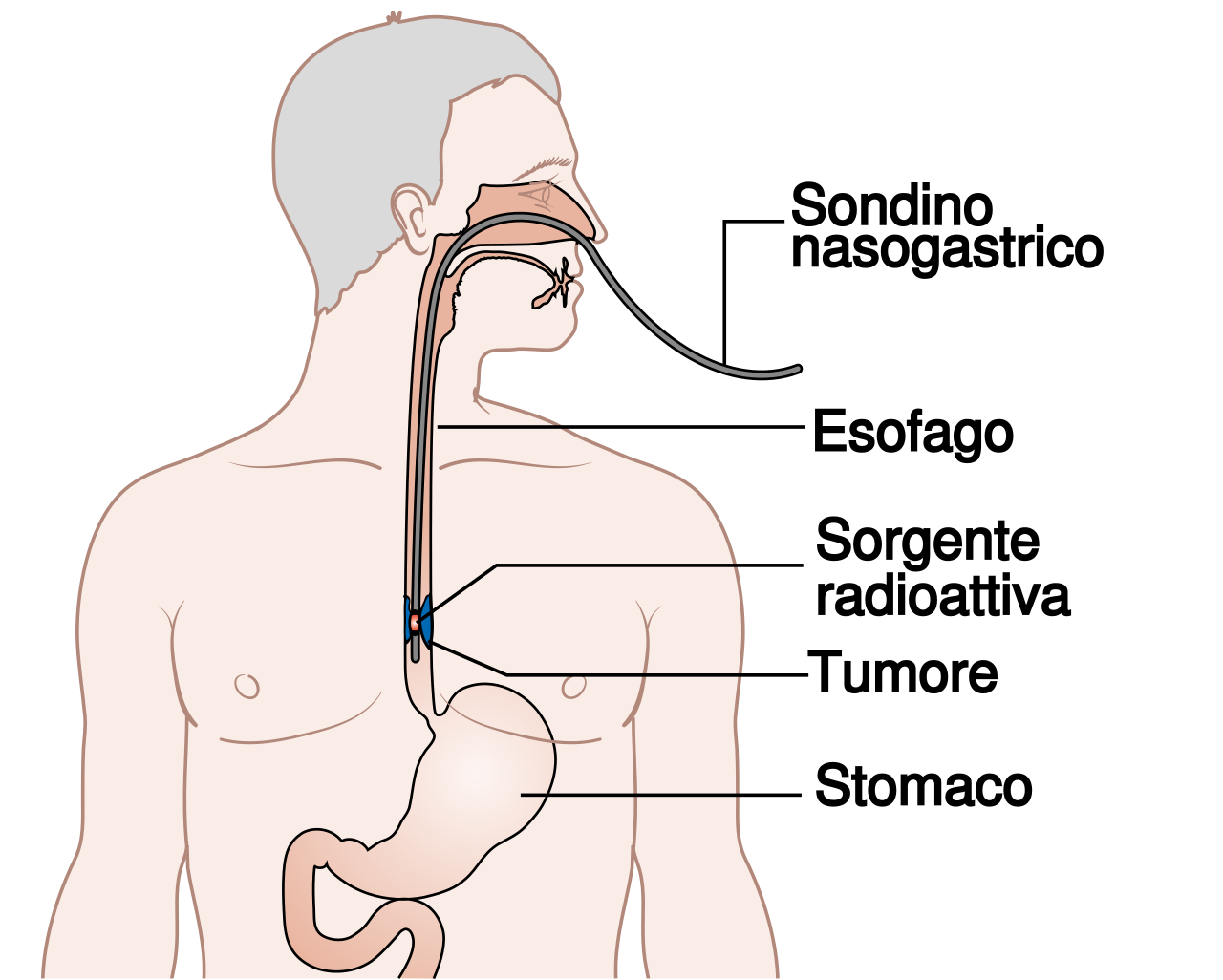 Sintomas cancer esofago terminal