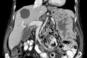 CT abdomen, coronal section, showing characteristic large rugal folds in the stomach. A cyst is also seen in the liver