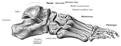 Thumbnail for Sinus tarsi syndrome