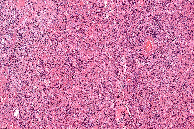 File:Splenic hamartoma - add - intermed mag.jpg