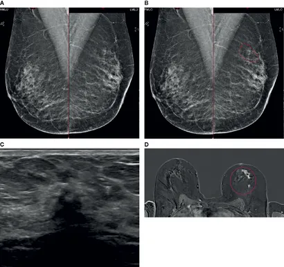 Fichier:A case of extensive ILC in a 50-year-old female attending for 1st breast screening.webp