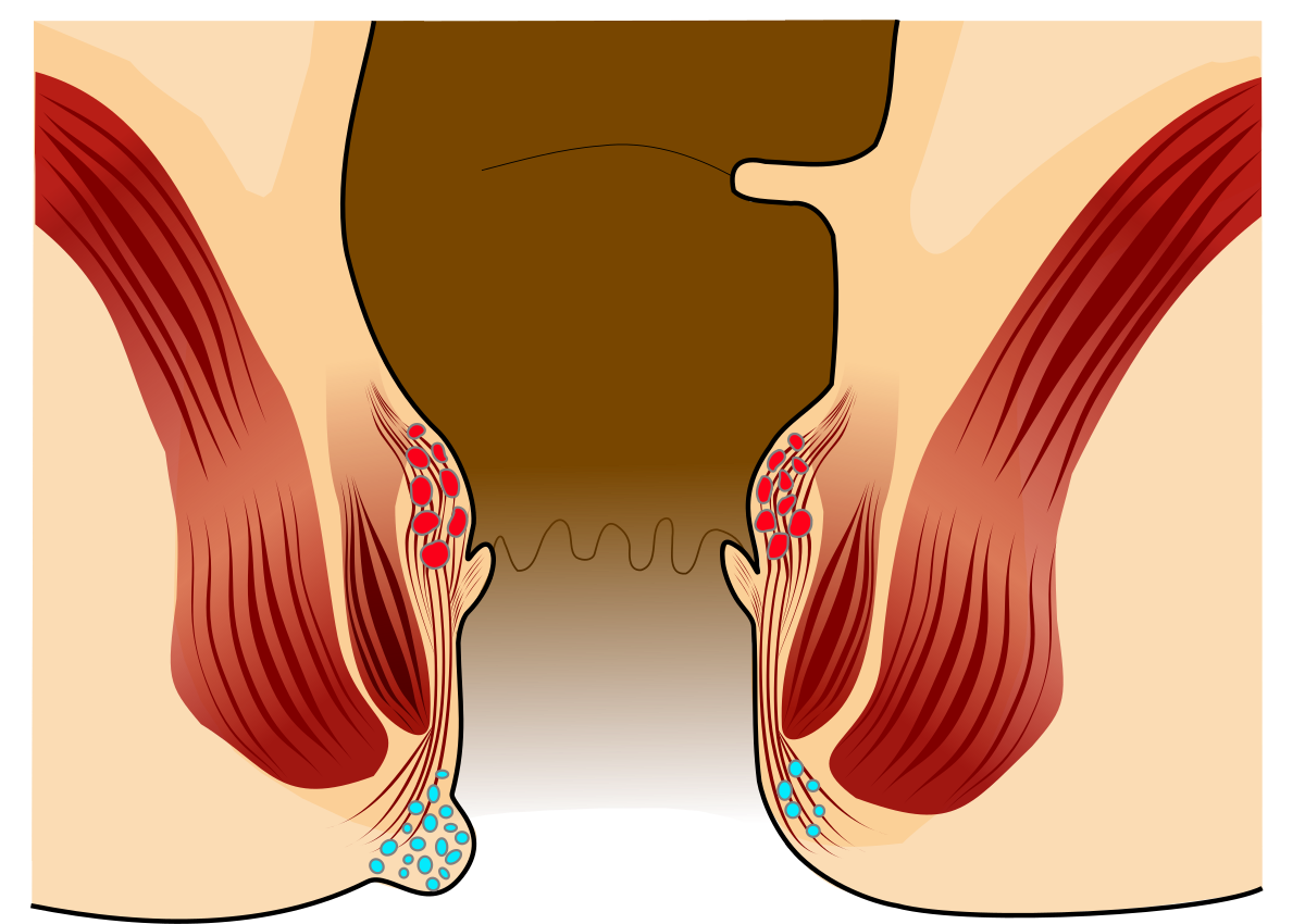 Perianal hematoma - Wikipedia