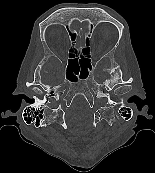 File:Aplasie des Sinus frontalis 62M - CT - 001.jpg