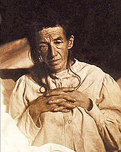 Alois Alzheimer's patient Auguste Deter in 1902. Hers was the first described case of what became known as Alzheimer's disease. Auguste D aus Marktbreit.jpg
