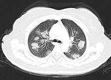 A CT scan of a person with COVID-19 shows lesions (bright regions) in the lungs COVID19CTPneumonia.jpg