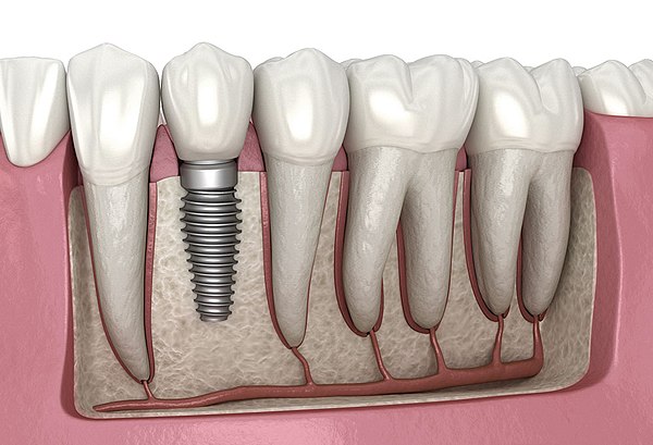 Dental Implant, 3D Illustration