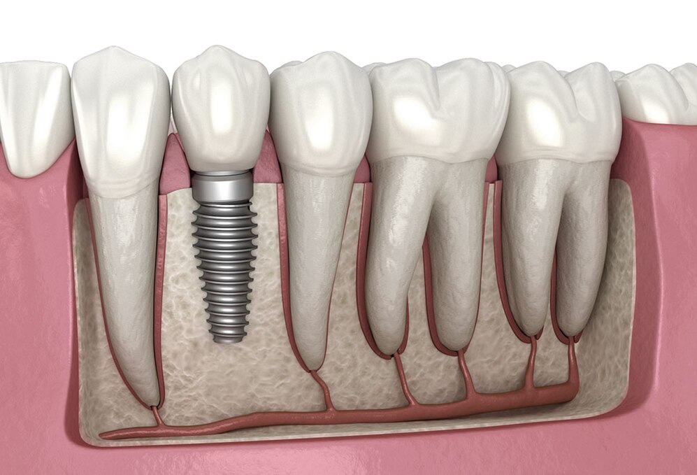 Dental Implant-avatar