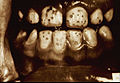 Dental fluorosis from the National Library of Medicine