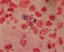 https://upload.wikimedia.org/wikipedia/commons/thumb/1/1d/Gram-positive_bacteria_and_pus_cells.jpg/220px-Gram-positive_bacteria_and_pus_cells.jpg
