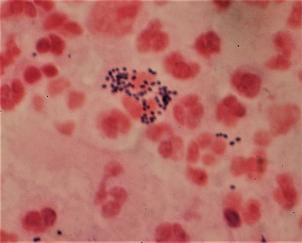 Gram-stain of gram-positive streptococci surrounded by pus cells