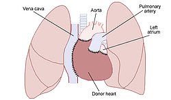 Heart transplant.jpg