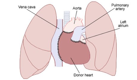 Heart transplantation