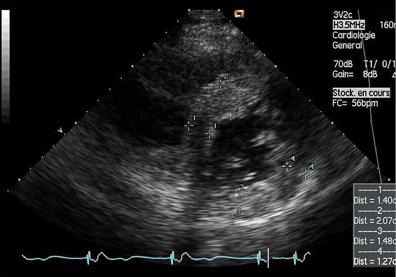 File:Morbus Fabry LVH echo 02.jpg