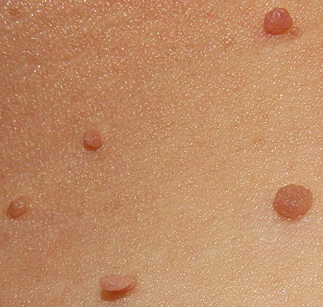 Skin Tags in the neck
