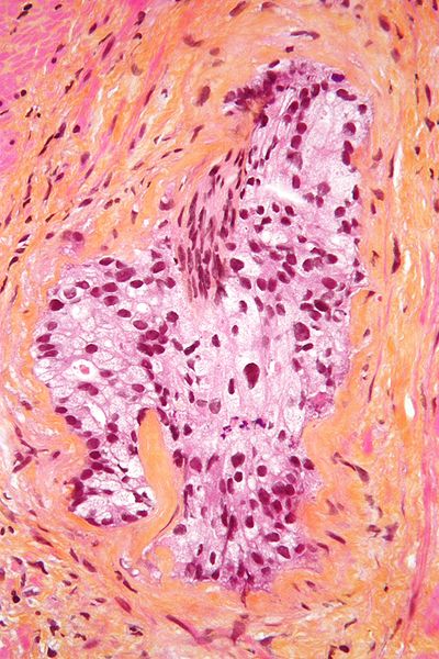 File:Perineural invasion prostate high mag.jpg