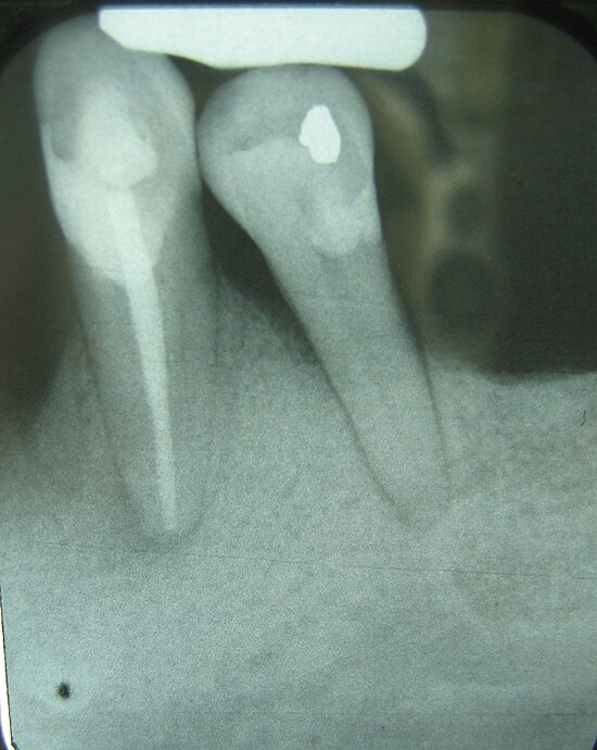 This X-ray film reveals a poor crown-to-root ratio for tooth #21 (right), the lower left first premolar. The tooth exhibits 50% bone loss, adding roughly 5-7 mm to the clinical crown of what is actually anatomical root. The fulcrum, existing somewhere immediately apical to the height of the bone, does not allow for any adjacent bone to avoid compression or tension, resulting in virtually complete widening of the PDL and a grim prognosis, due to secondary occlusal trauma. Periodontalboneloss.JPG