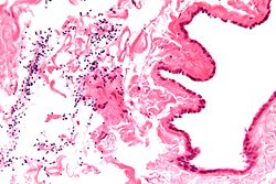 Micrograph of a spermatocele. The characteristic sperm are present (black dots - left of image). H&E stain.