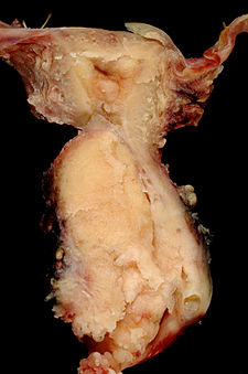 Spinocelulární karcinom děložního hrdla