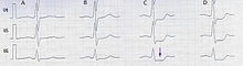 Horizontal ST depression in V4, V5, V6 leads during a cardiac stress ECG StressECG STDepression.jpg