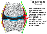 Positionierung des Tapeverbandes (grün). Knorpel (blau), Kapsel (rot), Band (gelb) Knochen (grau).